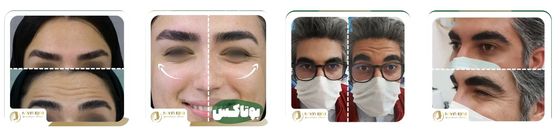 عکس های قبل و بعد بوتاکس در نوین ایرانا
